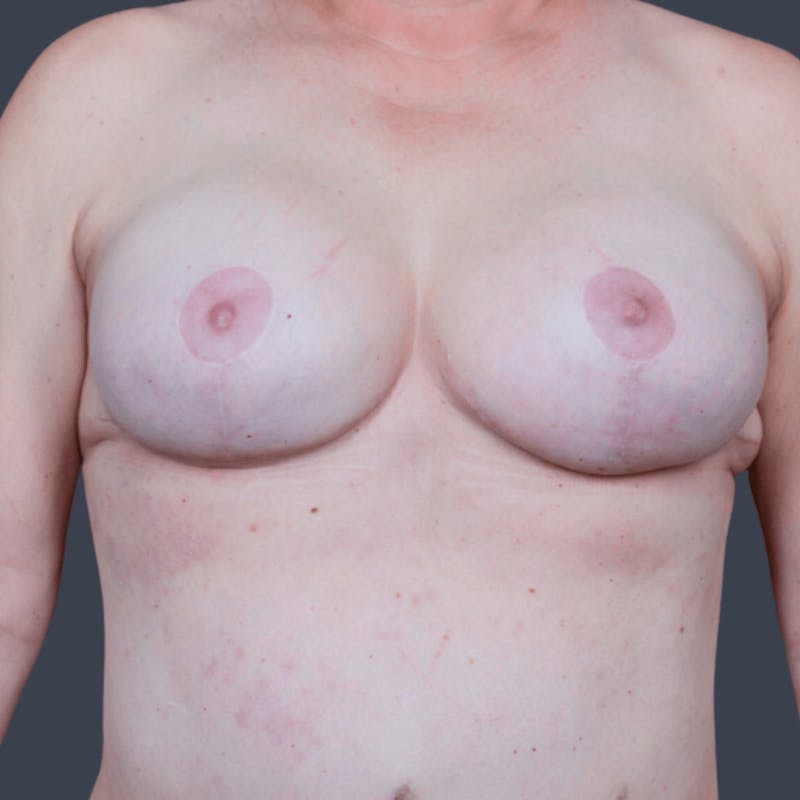Breast Reconstruction Revision Before & After Gallery - Patient 360330 - Image 2