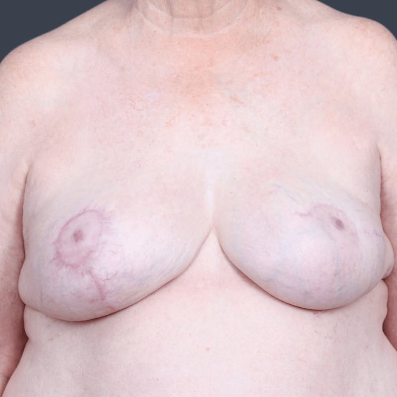 Breast Reconstruction Revision Before & After Gallery - Patient 414937 - Image 2