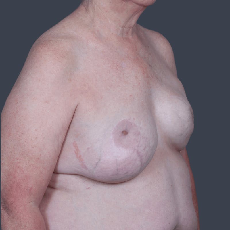 Breast Reconstruction Revision Before & After Gallery - Patient 414937 - Image 3