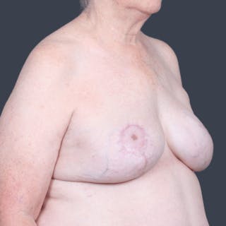 Breast Reconstruction Revision Before & After Gallery - Patient 414937 - Image 4