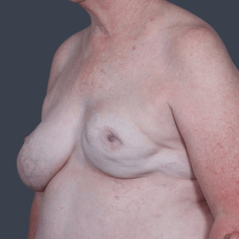Breast Reconstruction Revision Before & After Gallery - Patient 414937 - Image 5