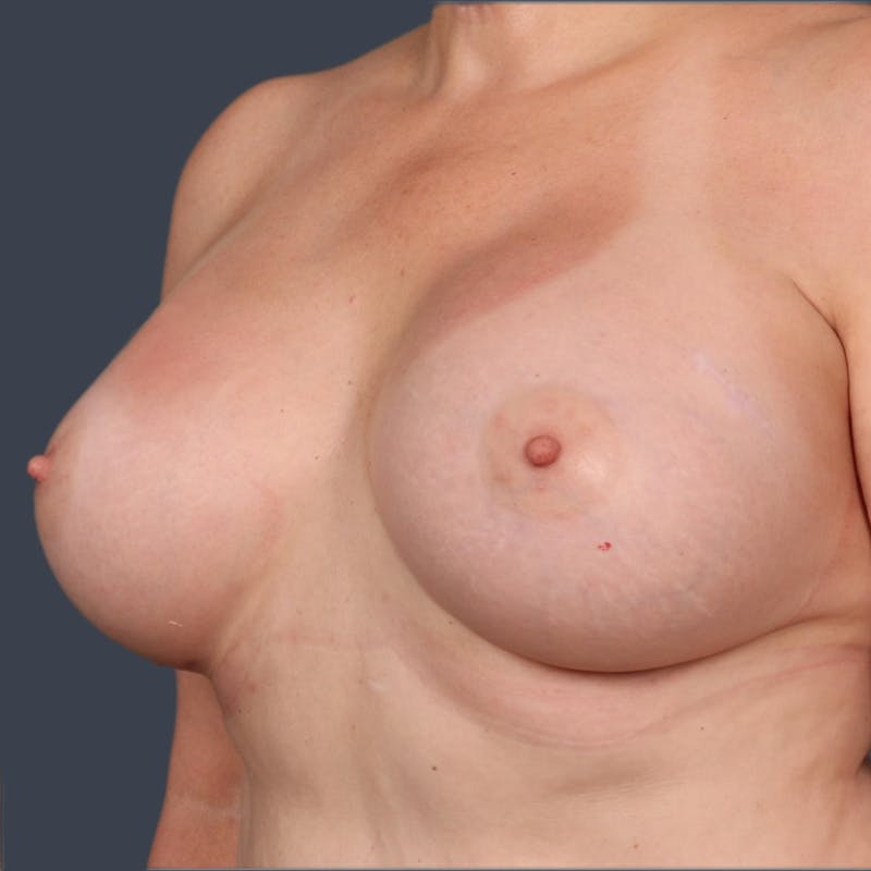 Breast Augmentation Before & After Gallery - Patient 934064 - Image 6