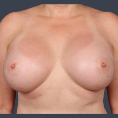 Breast Augmentation Before & After Gallery - Patient 934064 - Image 2