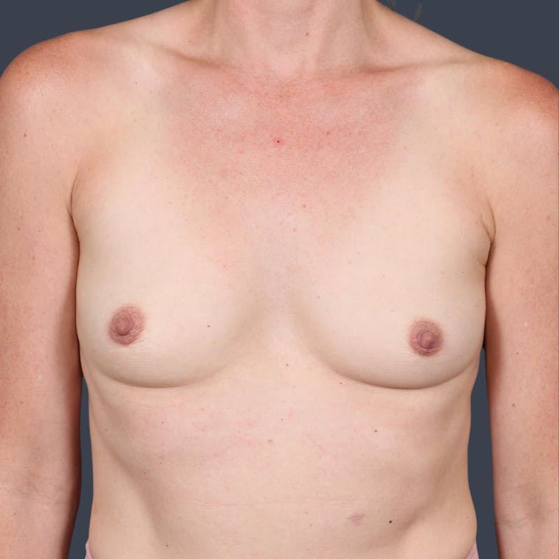 Breast Augmentation Before & After Gallery - Patient 328064 - Image 1