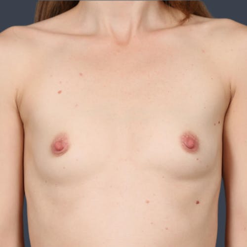 Before procedure image for Breast Augmentation