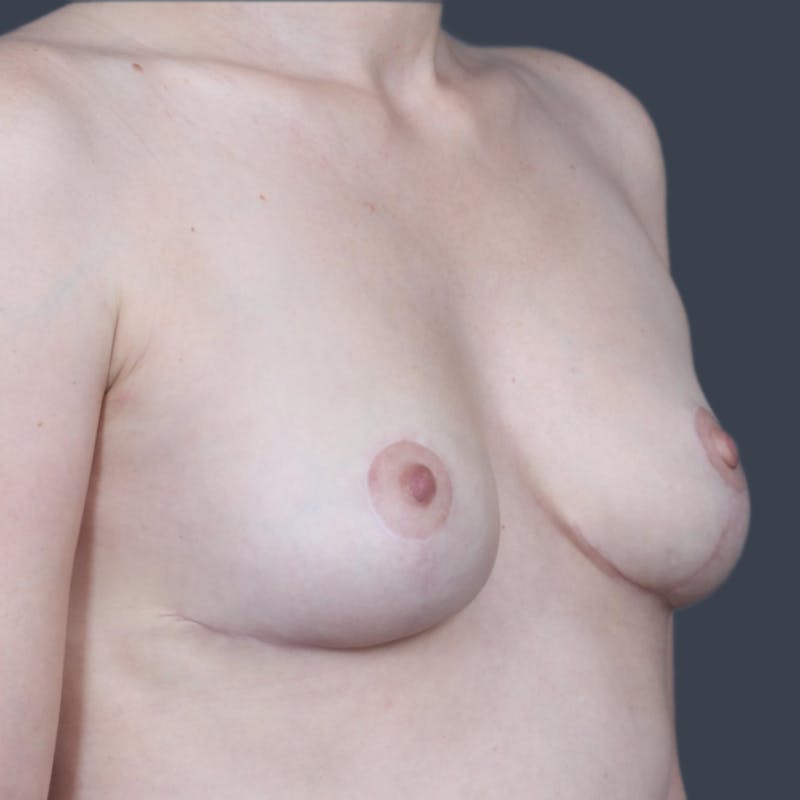 Breast Lift Before & After Gallery - Patient 711945 - Image 6