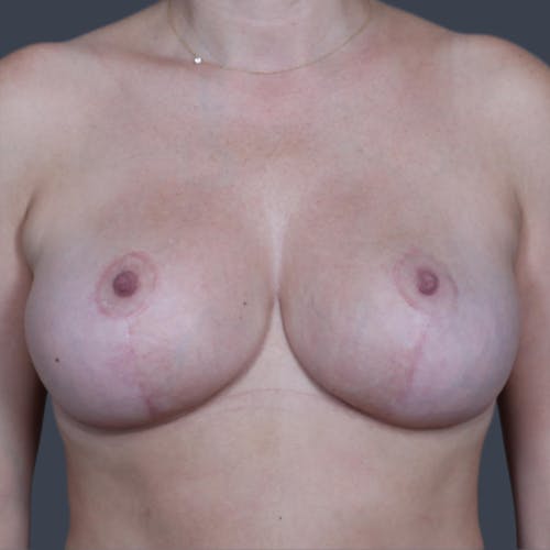 After procedure image for Breast Lift