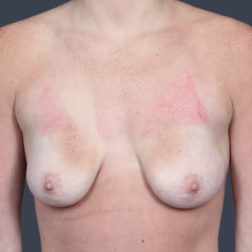 Before procedure image for Breast Lift