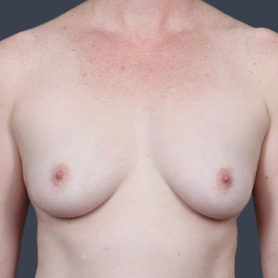 Breast Augmentation Before & After Gallery - Patient 227161 - Image 1