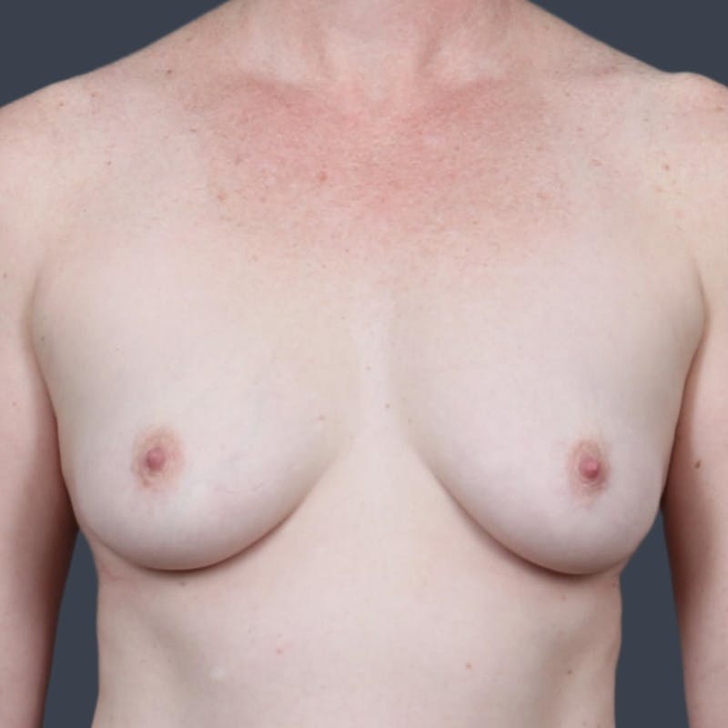 Breast Augmentation Before & After Gallery - Patient 213538 - Image 1