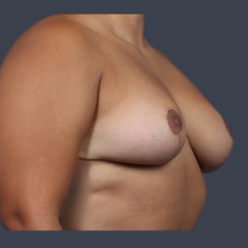 Implant Removal Before & After Gallery - Patient 146360 - Image 5