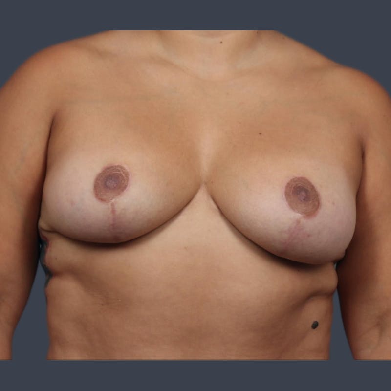 Implant Removal Before & After Gallery - Patient 146360 - Image 1
