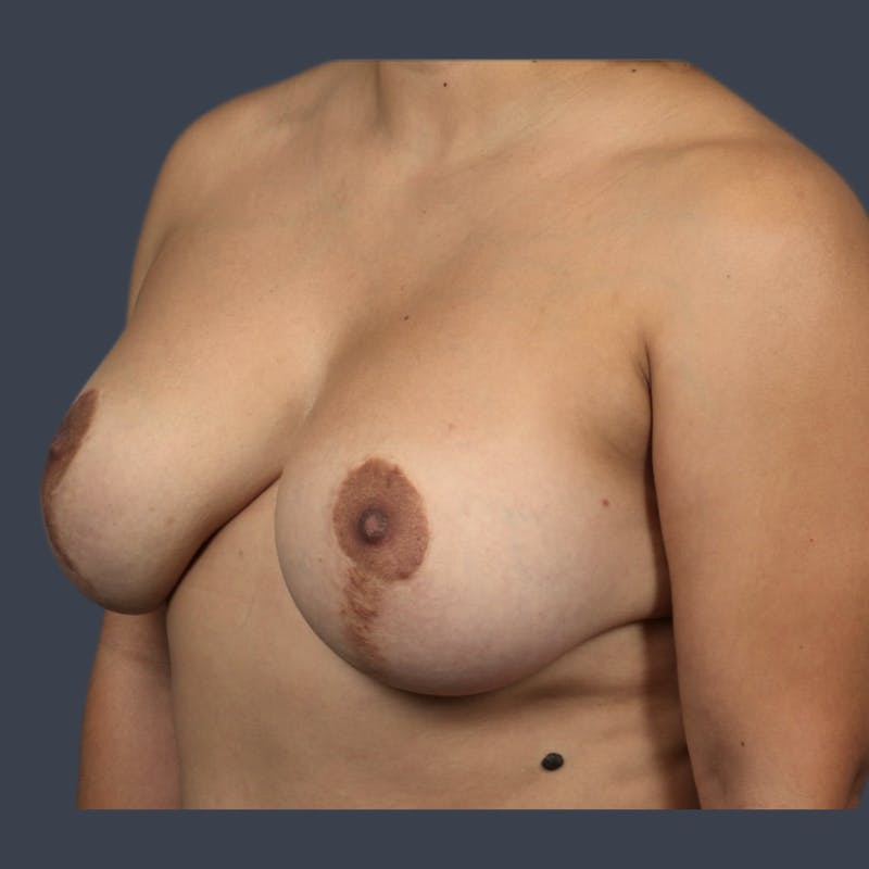 Implant Removal Before & After Gallery - Patient 146360 - Image 4