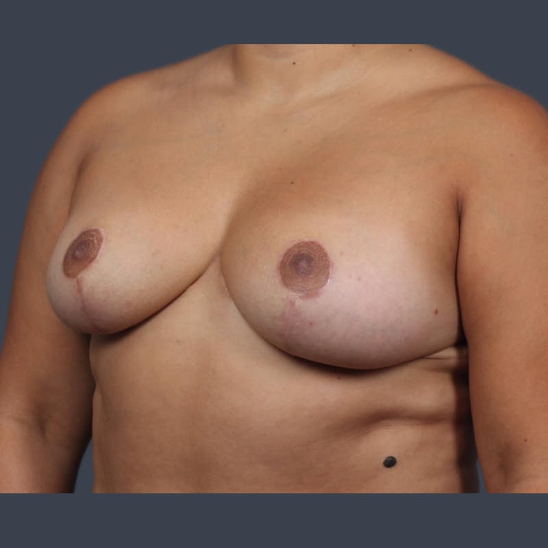 Implant Removal Before & After Gallery - Patient 146360 - Image 3