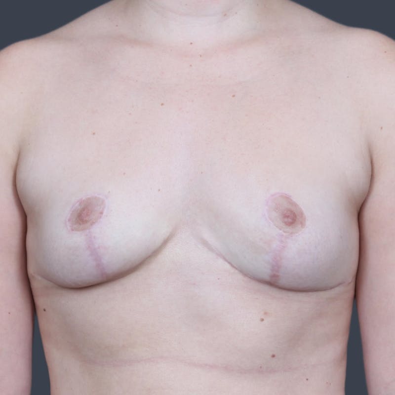 Implant Removal Before & After Gallery - Patient 271218 - Image 2