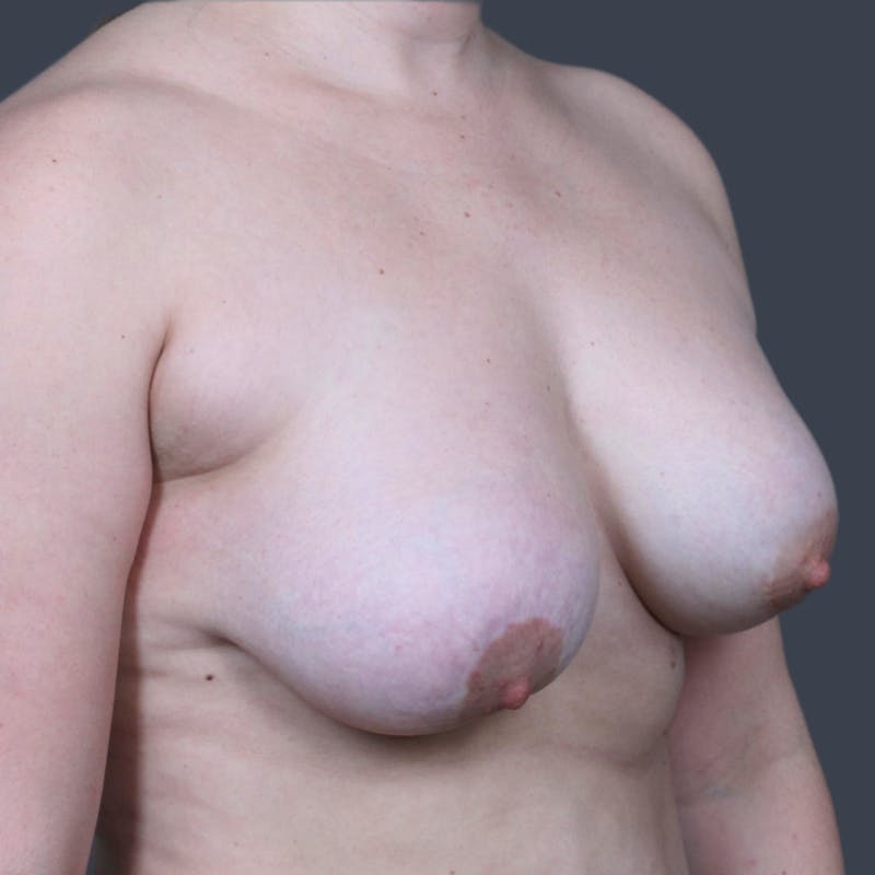 Implant Removal Before & After Gallery - Patient 271218 - Image 5