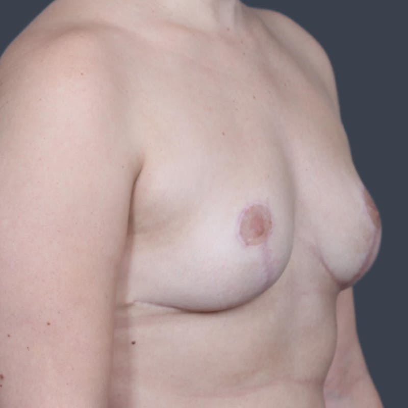 Implant Removal Before & After Gallery - Patient 271218 - Image 6