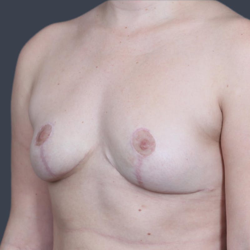 Implant Removal Before & After Gallery - Patient 271218 - Image 4