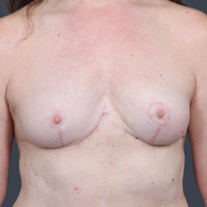 Implant Removal Before & After Gallery - Patient 101005 - Image 2