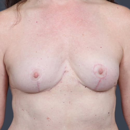 After procedure image for Implant Removal