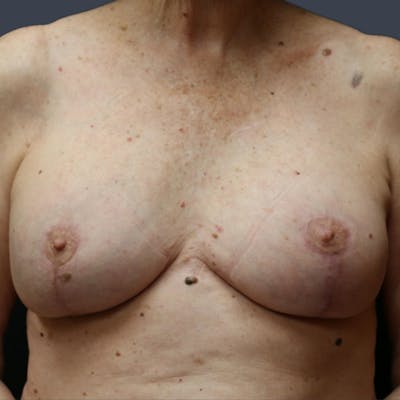 Implant Exchange Before & After Gallery - Patient 118999 - Image 2