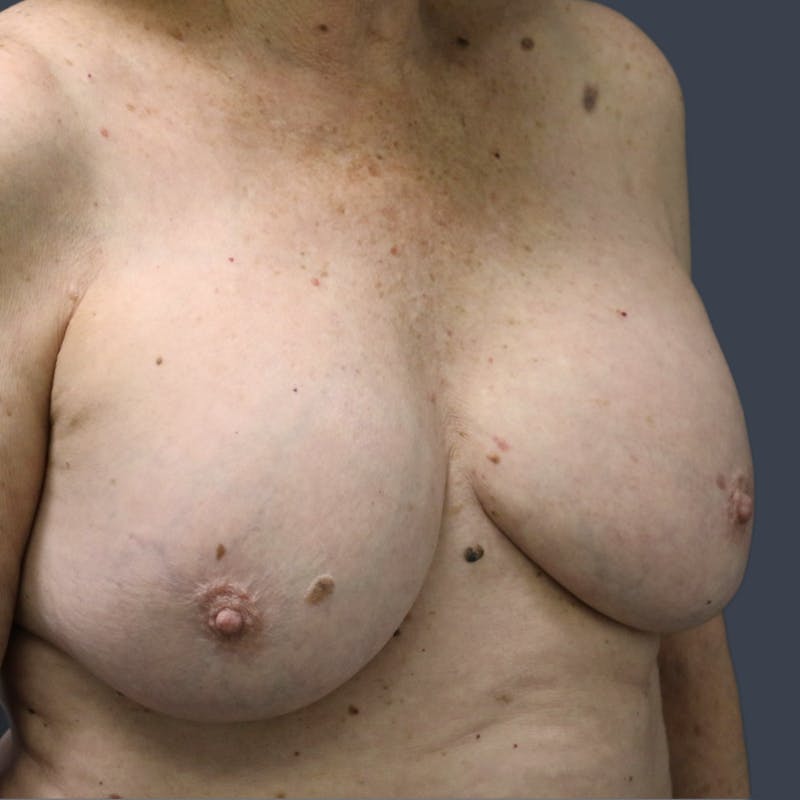 Implant Exchange Before & After Gallery - Patient 179290 - Image 5