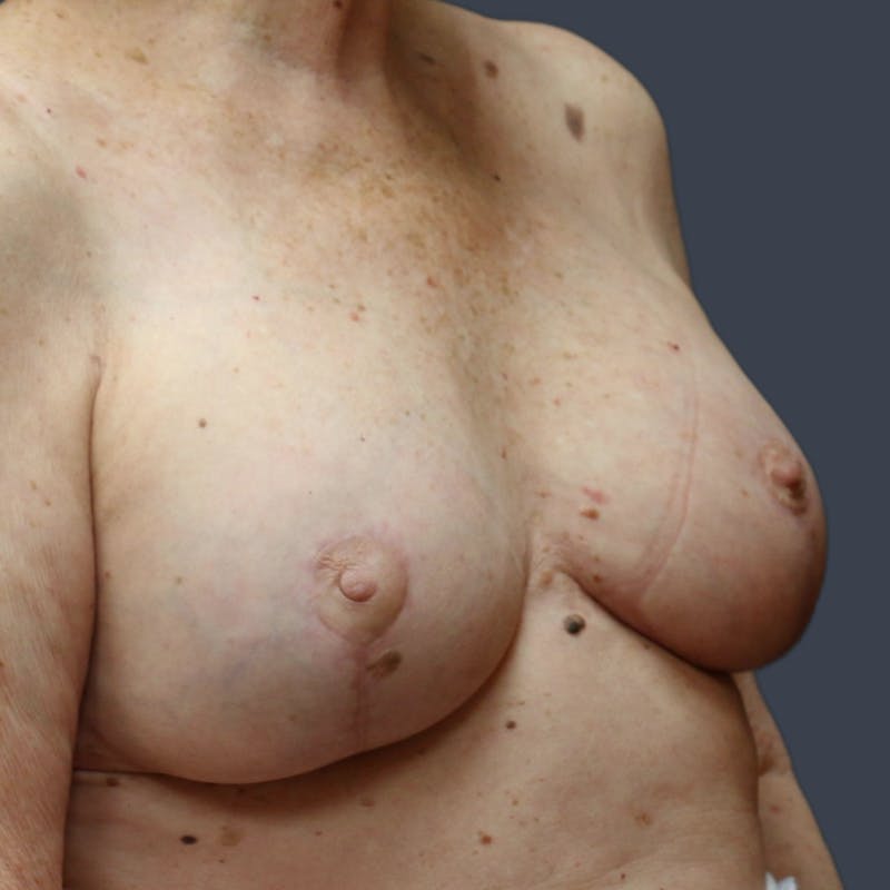 Implant Exchange Before & After Gallery - Patient 179290 - Image 6