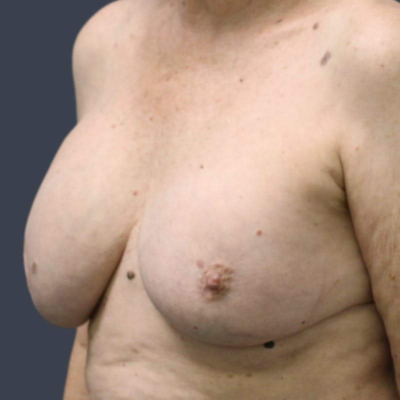 Implant Exchange Before & After Gallery - Patient 179290 - Image 3