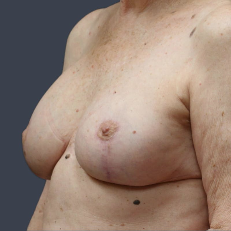 Implant Exchange Before & After Gallery - Patient 179290 - Image 4