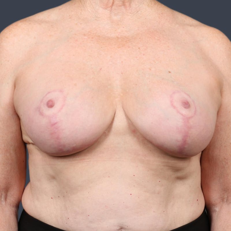 Implant Exchange Before & After Gallery - Patient 474006 - Image 2