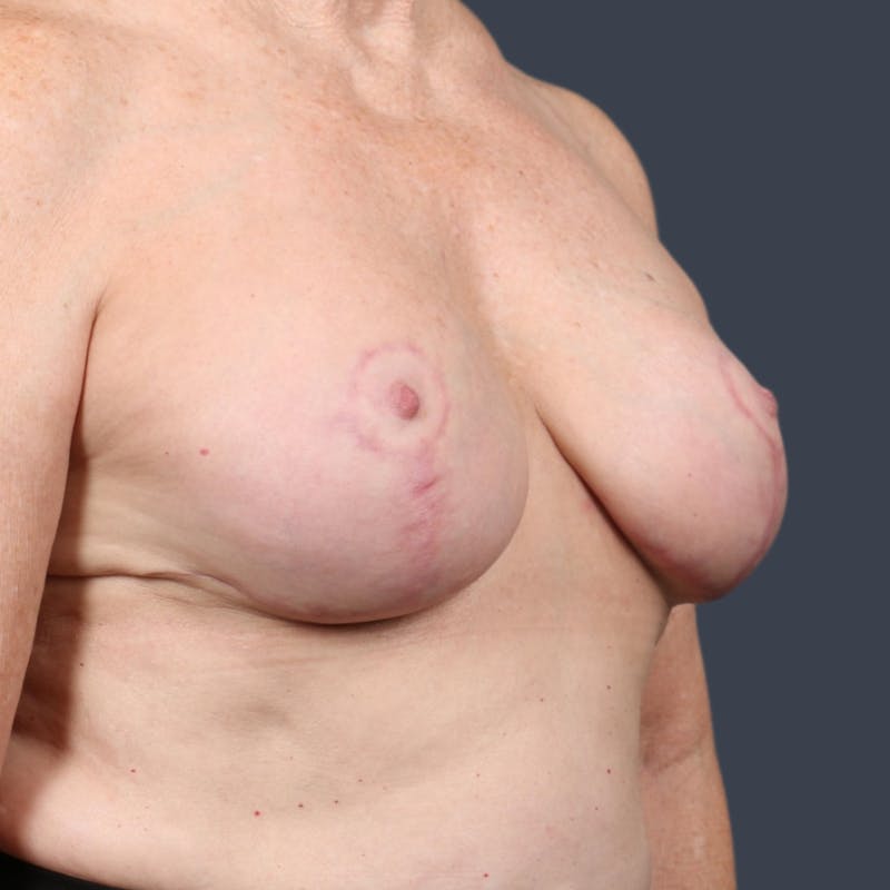 Implant Exchange Before & After Gallery - Patient 474006 - Image 6