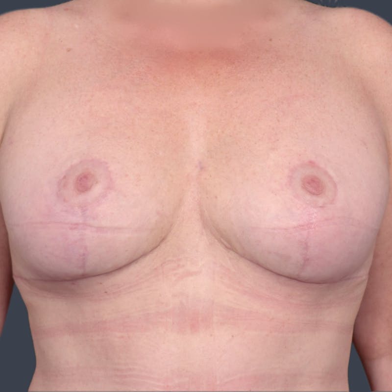 Implant Exchange Before & After Gallery - Patient 744628 - Image 2