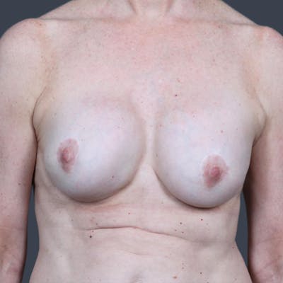 Implant Exchange Before & After Gallery - Patient 793434 - Image 1