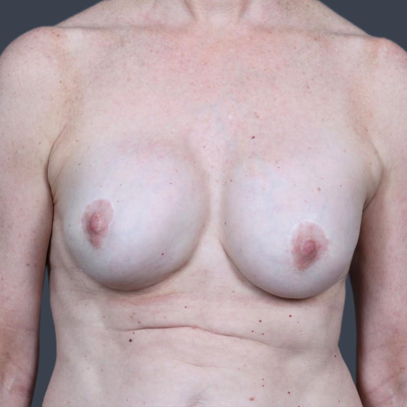 Implant Exchange Before & After Gallery - Patient 305043 - Image 1