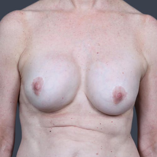 Before procedure image for Implant Exchange