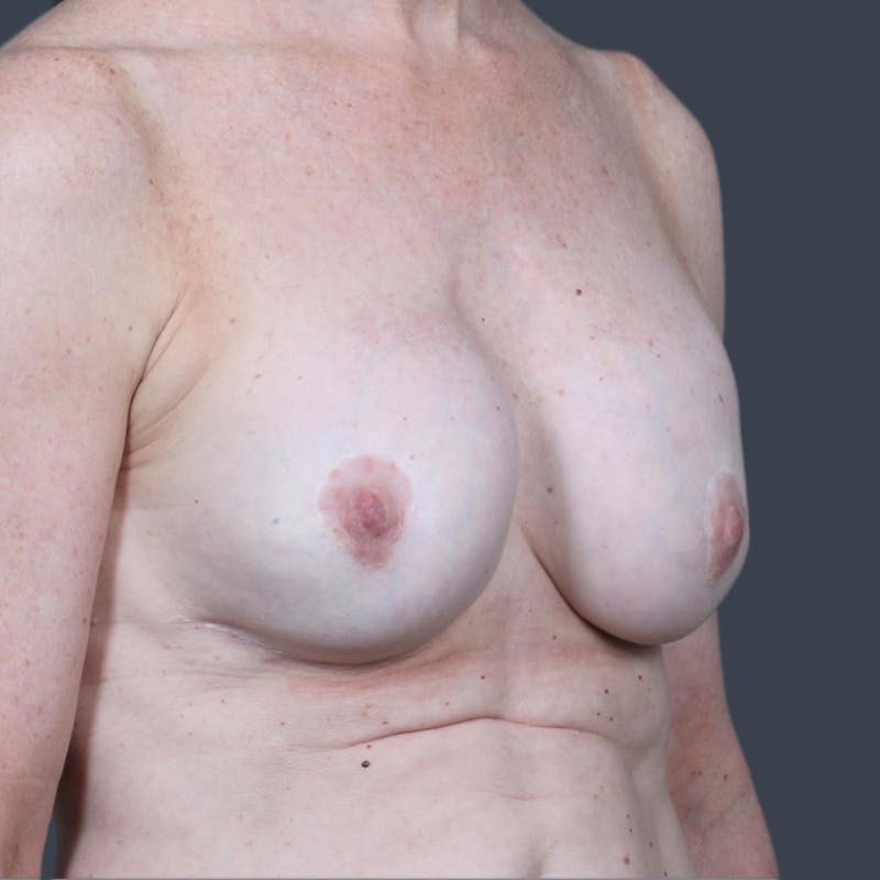 Implant Exchange Before & After Gallery - Patient 305043 - Image 5