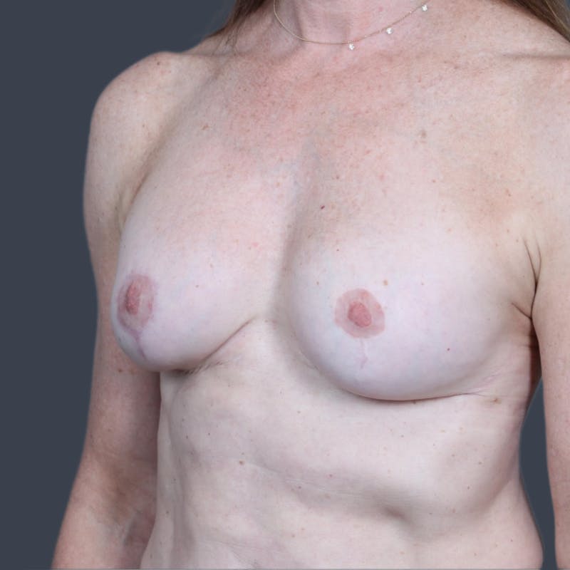 Implant Exchange Before & After Gallery - Patient 305043 - Image 4