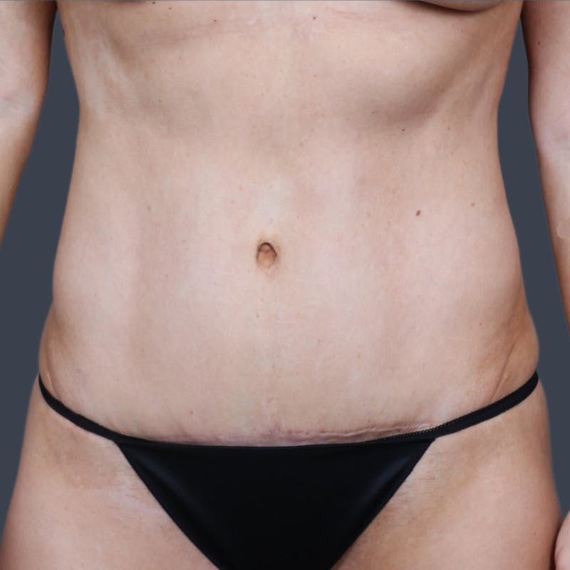Abdominoplasty / Tummy Tuck Before & After Gallery - Patient 175265 - Image 2
