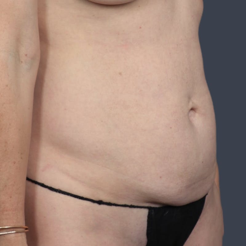 Abdominoplasty / Tummy Tuck Before & After Gallery - Patient 175265 - Image 5
