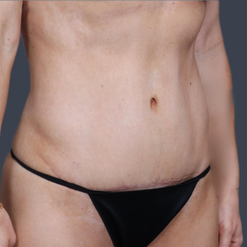Abdominoplasty / Tummy Tuck Before & After Gallery - Patient 175265 - Image 6