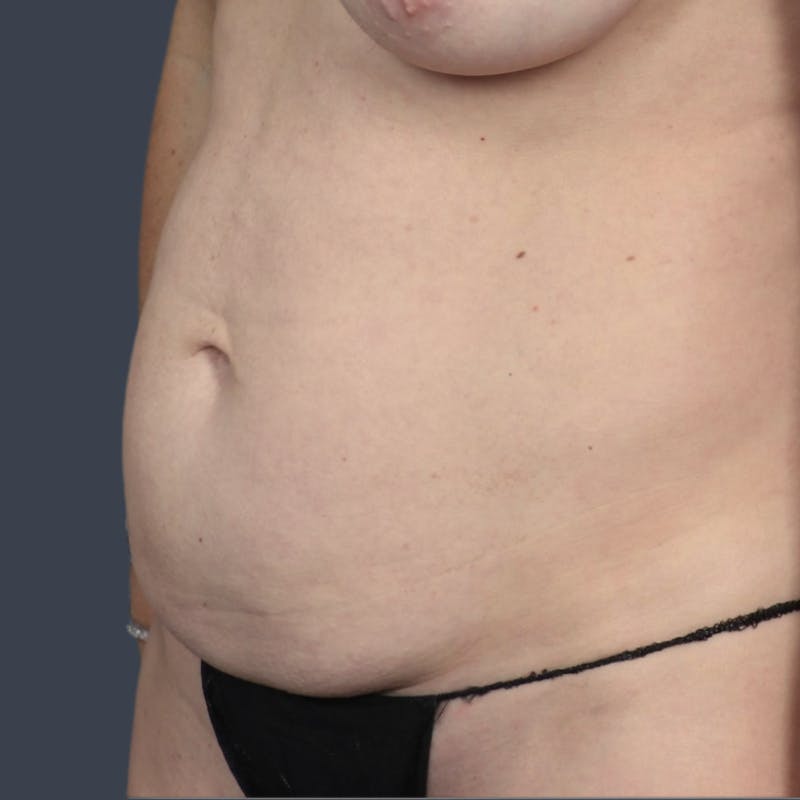Abdominoplasty / Tummy Tuck Before & After Gallery - Patient 175265 - Image 3