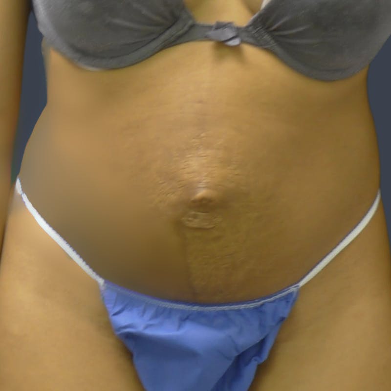Abdominoplasty / Tummy Tuck Before & After Gallery - Patient 254263 - Image 1