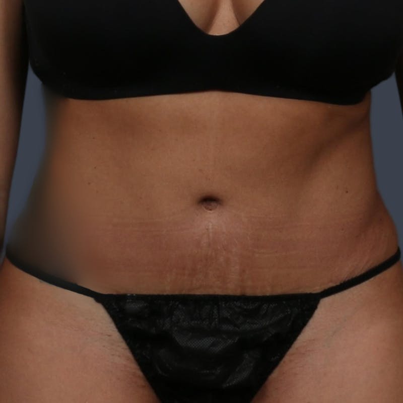 Abdominoplasty / Tummy Tuck Before & After Gallery - Patient 254263 - Image 2