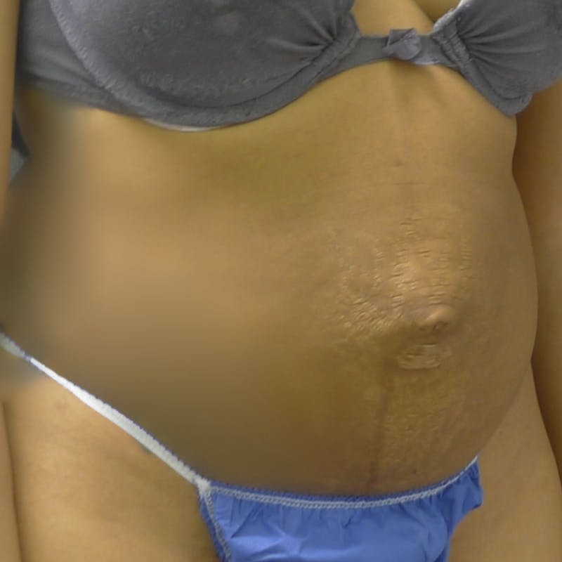 Abdominoplasty / Tummy Tuck Before & After Gallery - Patient 254263 - Image 5
