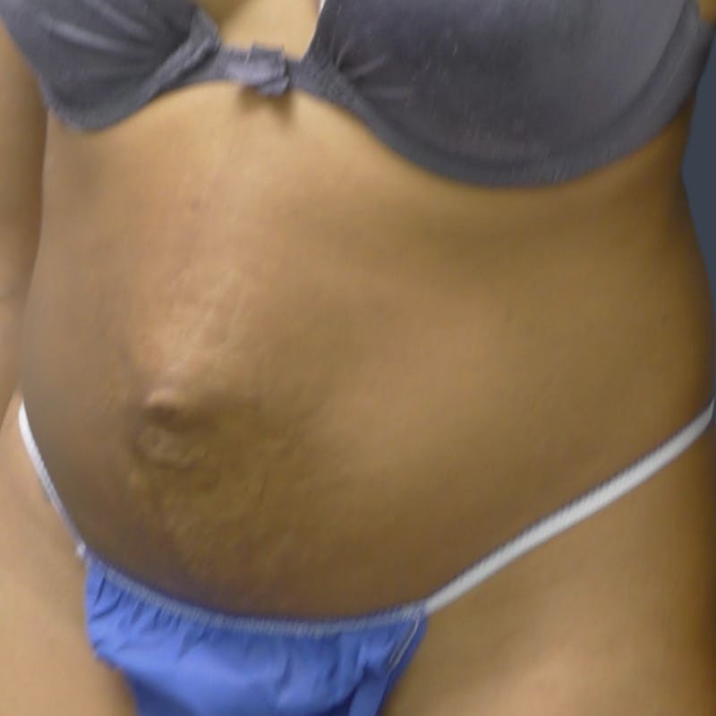 Abdominoplasty / Tummy Tuck Before & After Gallery - Patient 254263 - Image 3
