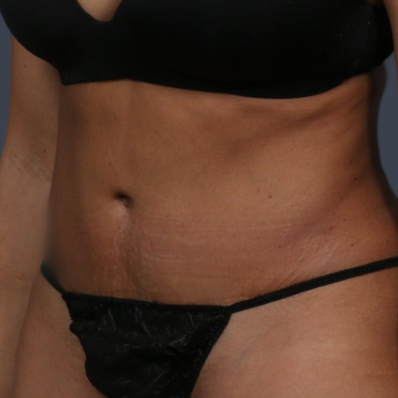 Abdominoplasty / Tummy Tuck Before & After Gallery - Patient 254263 - Image 4