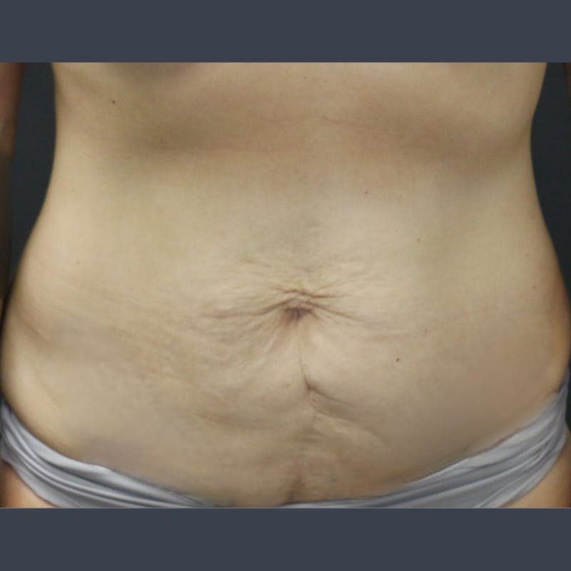 Abdominoplasty / Tummy Tuck Before & After Gallery - Patient 275267 - Image 1