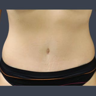 Abdominoplasty / Tummy Tuck Before & After Gallery - Patient 275267 - Image 2
