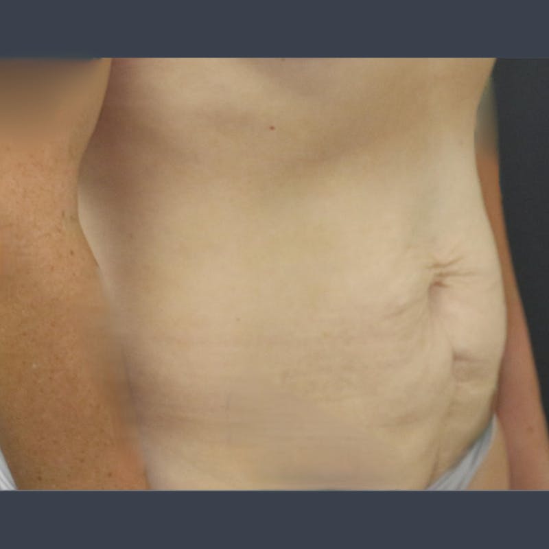 Abdominoplasty / Tummy Tuck Before & After Gallery - Patient 275267 - Image 5
