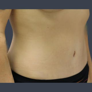 Abdominoplasty / Tummy Tuck Before & After Gallery - Patient 275267 - Image 6